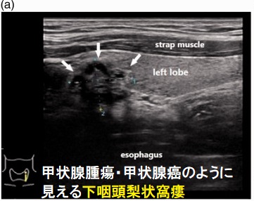 甲状腺腫瘍・甲状腺癌のように見える下咽頭梨状窩瘻 甲状腺腫瘍・甲状腺癌のように見える下咽頭梨状窩瘻