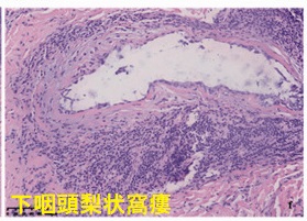 甲状腺腫瘍・甲状腺癌のように見える下咽頭梨状窩瘻 組織像 甲状腺腫瘍・甲状腺癌のように見える下咽頭梨状窩瘻 組織像