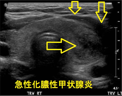 急性化膿性甲状腺炎 超音波(エコー)画像 急性化膿性甲状腺炎 超音波(エコー)画像