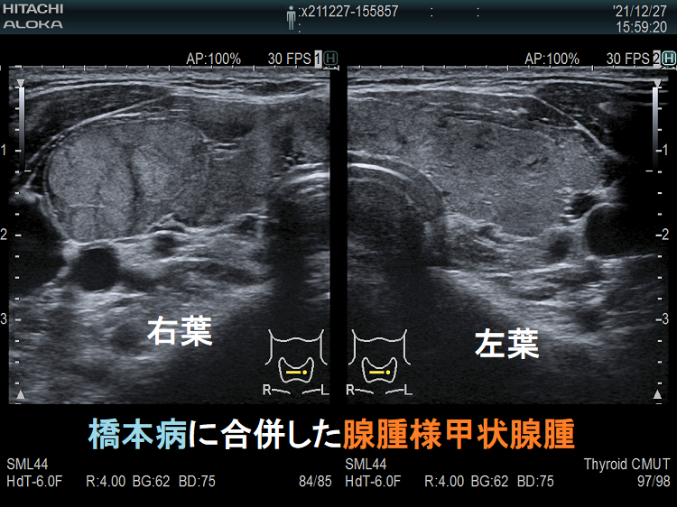 橋本病を基盤とする腺腫様甲状腺腫 橋本病を基盤とする腺腫様甲状腺腫