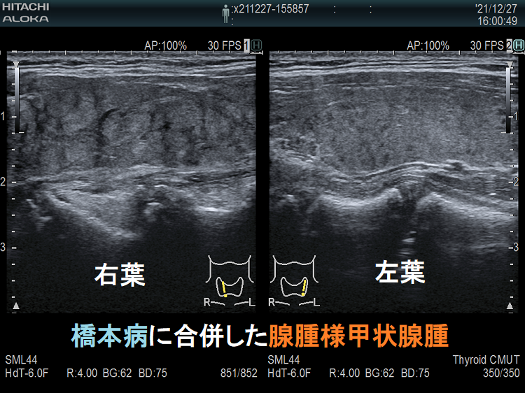橋本病を基盤とする腺腫様甲状腺腫 橋本病を基盤とする腺腫様甲状腺腫