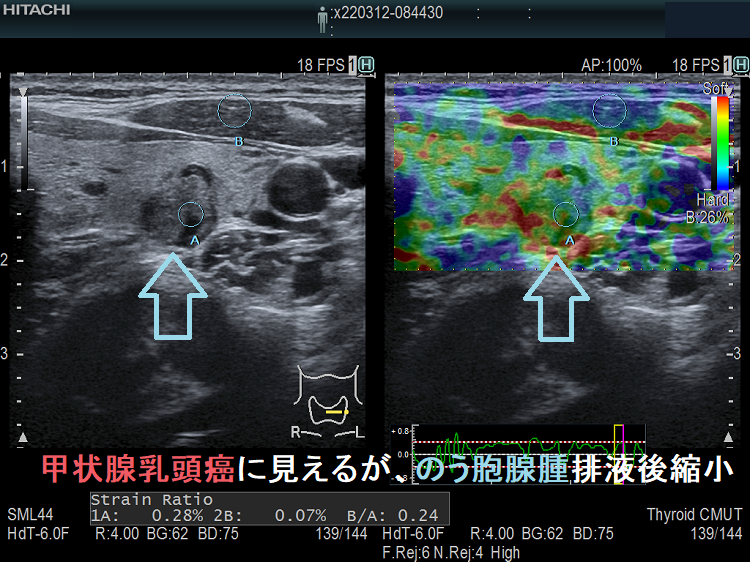 甲状腺のう胞腺腫 排液後縮小し甲状腺乳頭癌のように見える。エラストグラフィー。 甲状腺のう胞腺腫 排液後縮小し甲状腺乳頭癌のように見える。エラストグラフィー。