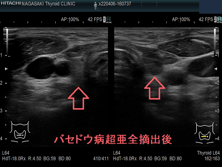 バセドウ病超亜全摘術(準全摘術)後 超音波(エコー)画像 バセドウ病超亜全摘術(準全摘術)後 超音波(エコー)画像