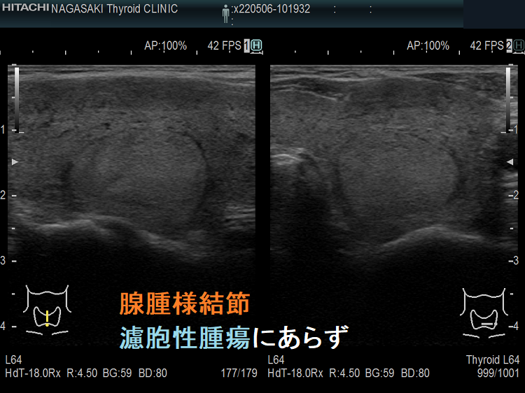 腺腫様結節(濾胞性腫瘍と鑑別難)超音波(エコー)画像 腺腫様結節(濾胞性腫瘍と鑑別難)超音波(エコー)画像