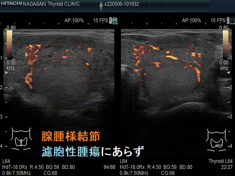 腺腫様結節(濾胞性腫瘍と鑑別難)ドプラー 腺腫様結節(濾胞性腫瘍と鑑別難)ドプラー
