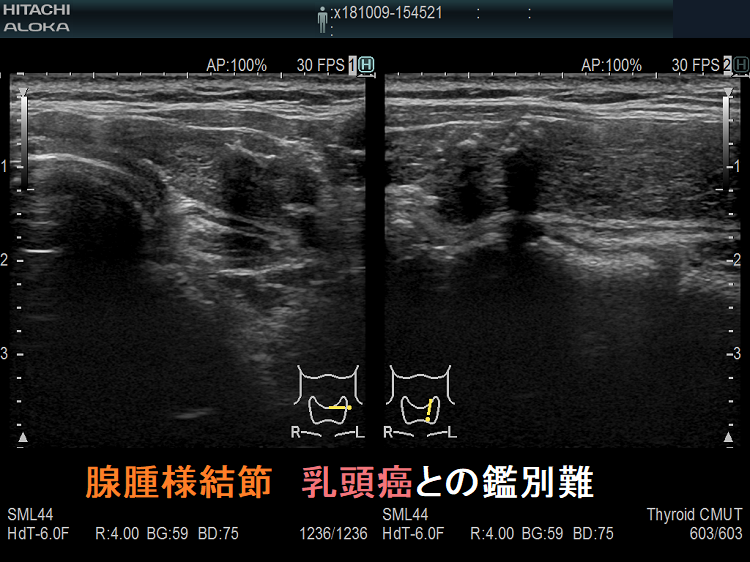 甲状腺乳頭癌・髄様癌に見えるが腺腫様結節 腺腫様結節 乳頭癌との鑑別難
