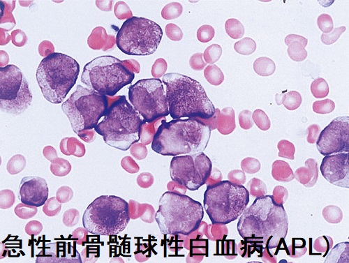 急性前骨髄球性白血病(APL) 急性前骨髄球性白血病(APL)