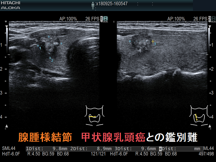 腺腫様結節 甲状腺乳頭癌との鑑別難 腺腫様結節 甲状腺乳頭癌との鑑別難