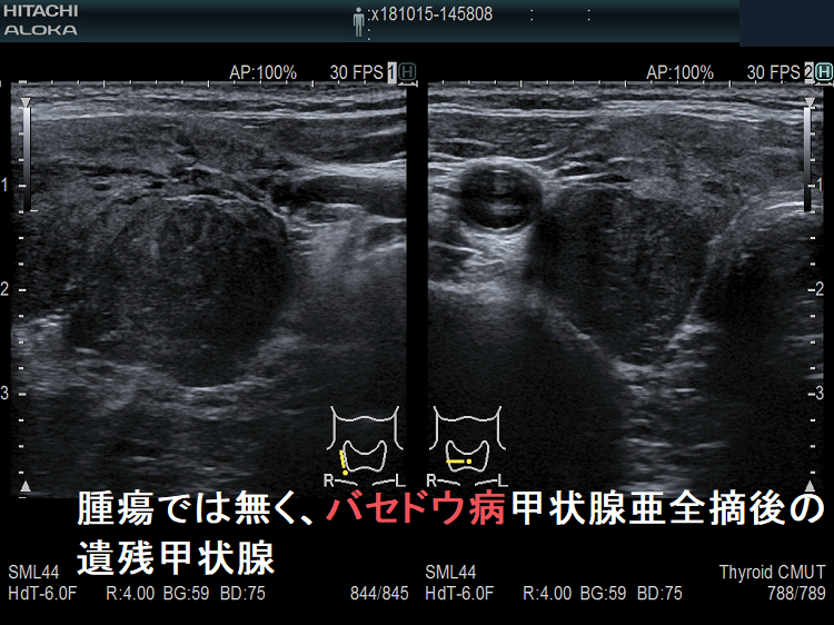 腫瘍では無く、バセドウ病甲状腺亜全摘後の遺残甲状腺 超音波(エコー)画像 腫瘍では無く、バセドウ病甲状腺亜全摘後の遺残甲状腺 超音波(エコー)画像