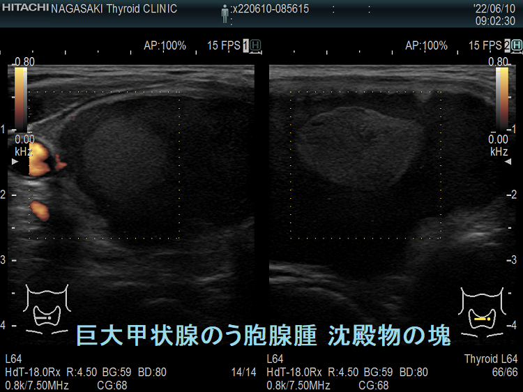 巨大甲状腺のう胞腺腫 沈殿物の塊 巨大甲状腺のう胞腺腫 沈殿物の塊
