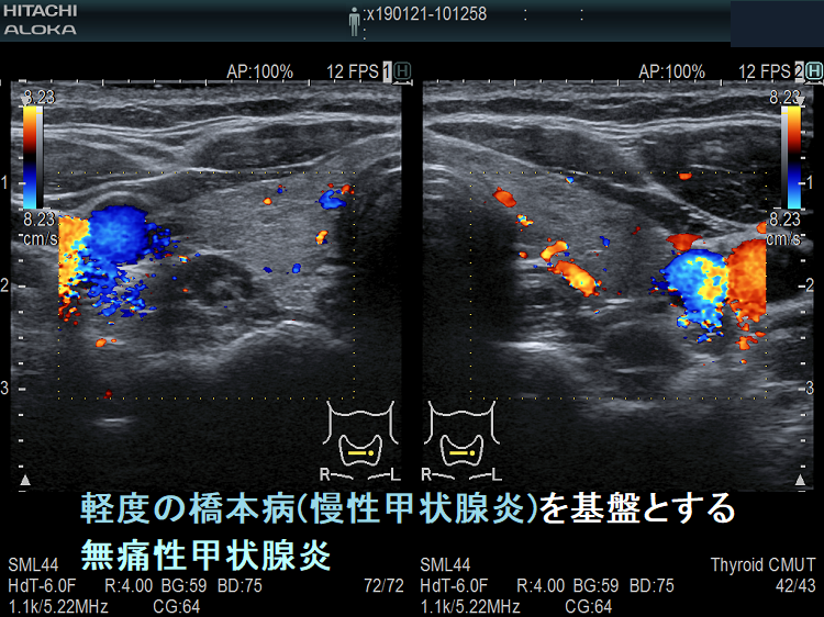 軽度橋本病(慢性甲状腺炎)を基盤とする無痛性甲状腺炎の血流 軽度橋本病(慢性甲状腺炎)を基盤とする無痛性甲状腺炎の血流