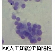 AI(人工知能)で甲状腺病理診断 偽陽性 AI(人工知能)で甲状腺病理診断 偽陽性