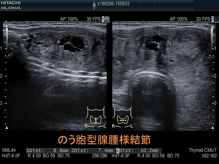 のう胞型腺腫様結節 超音波(エコー)画像 のう胞型腺腫様結節 超音波(エコー)画像