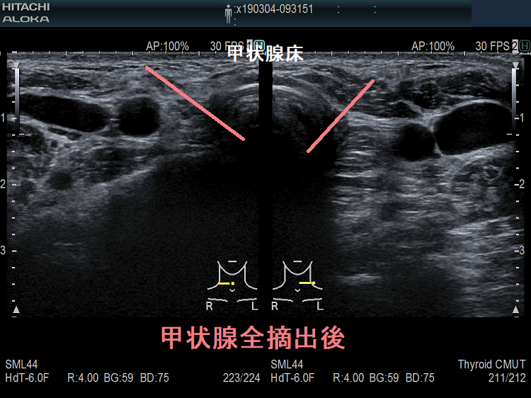 甲状腺全摘出後 超音波(エコー)画像 甲状腺全摘出後 超音波(エコー)画像