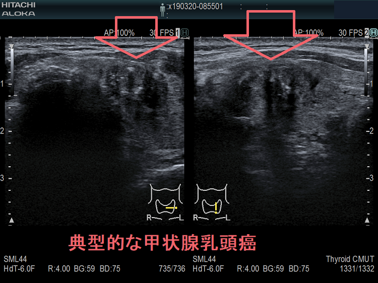 典型的な甲状腺乳頭癌 超音波(エコー)画像 典型的な甲状腺乳頭癌 超音波(エコー)画像