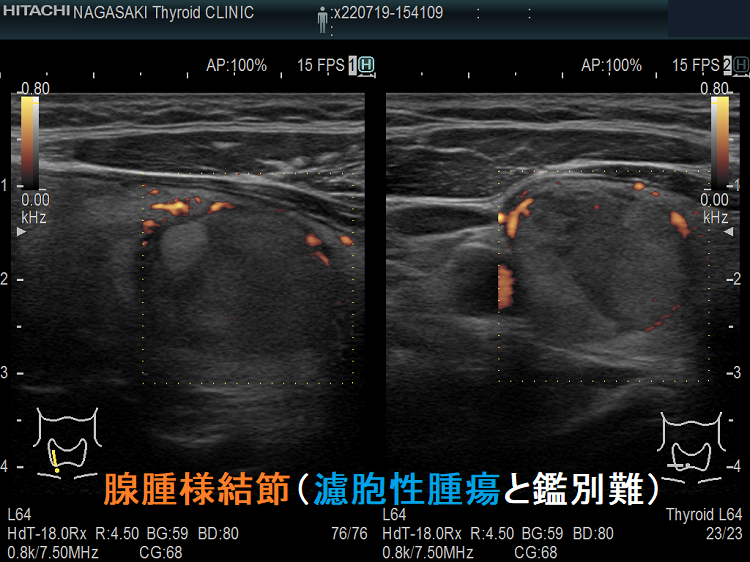 腺腫様結節(濾胞性腫瘍と鑑別難)ドプラーモード 腺腫様結節(濾胞性腫瘍と鑑別難)ドプラーモード