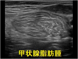 甲状腺脂肪腫 超音波(エコー)画像 甲状腺脂肪腫 超音波(エコー)画像