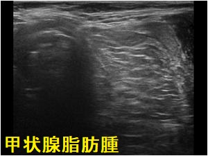 甲状腺脂肪腫 超音波(エコー)画像 甲状腺脂肪腫 超音波(エコー)画像