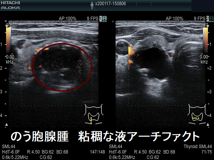 甲状腺のう胞腺腫 粘稠な液 アーチファクト 甲状腺のう胞腺腫 粘稠な液 アーチファクト