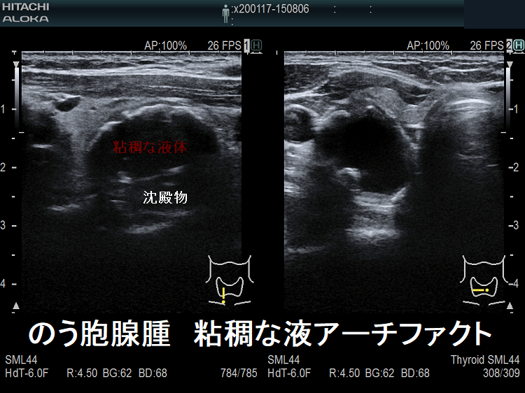甲状腺のう胞腺腫 粘稠な液アーチファクト 甲状腺のう胞腺腫 粘稠な液アーチファクト