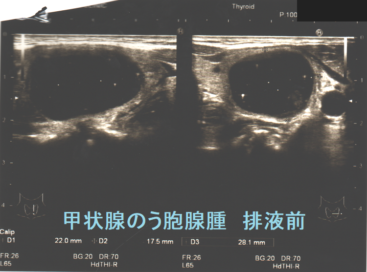 排液前の甲状腺のう胞腺腫 超音波(エコー)画像 排液前の甲状腺のう胞腺腫 超音波(エコー)画像