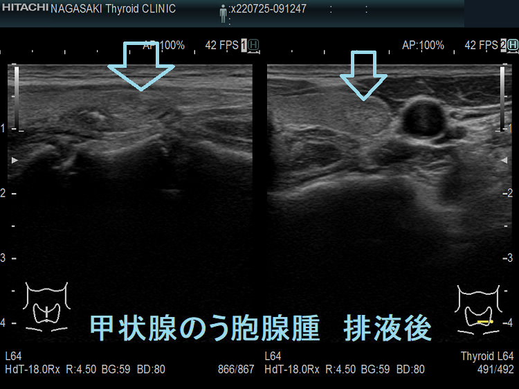 排液後縮小した甲状腺のう胞腺腫 超音波(エコー)画像 排液後縮小した甲状腺のう胞腺腫 超音波(エコー)画像