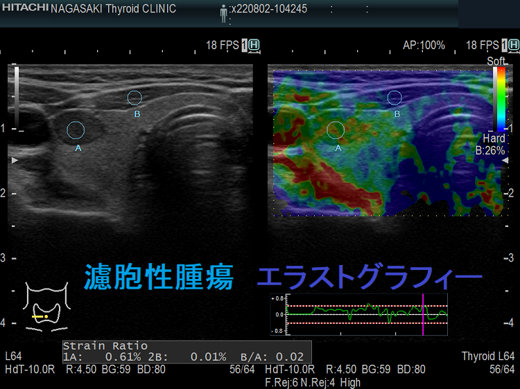 甲状腺濾胞性腫瘍 エラストグラフィー 甲状腺濾胞性腫瘍 エラストグラフィー