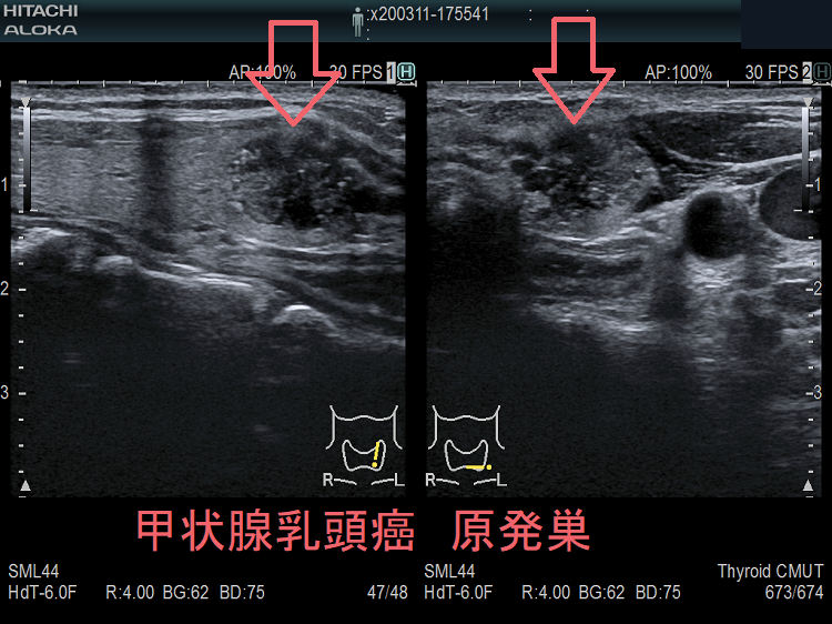 周囲にリンパ節転移を伴う甲状腺乳頭癌の原発巣 超音波(エコー)画像 周囲にリンパ節転移を伴う甲状腺乳頭癌の原発巣 超音波(エコー)画像