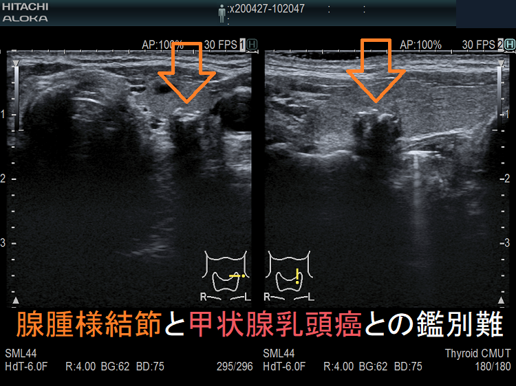 腺腫様甲状腺腫と甲状腺乳頭癌との鑑別難 腺腫様甲状腺腫と甲状腺乳頭癌との鑑別難