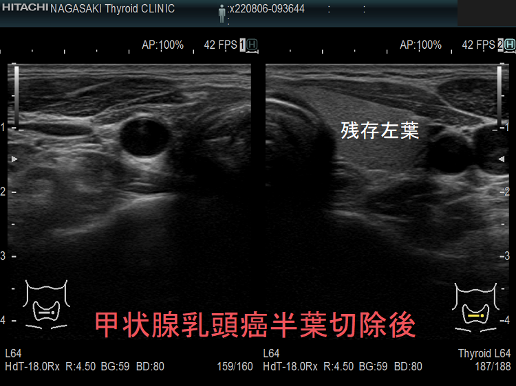 甲状腺乳頭癌の治療 外科手術;甲状腺全摘出,甲状腺片葉切除,予防