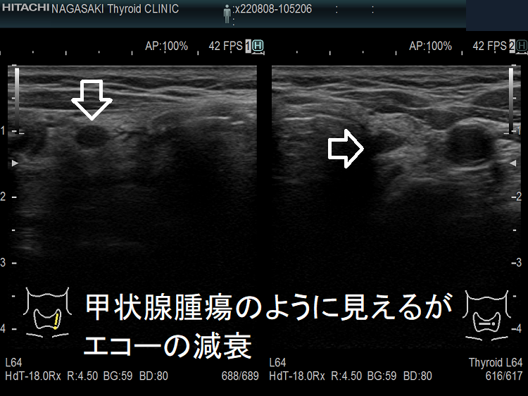 甲状腺腫瘍のように見えるがエコーの減衰 甲状腺腫瘍のように見えるがエコーの減衰