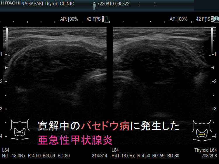 寛解中のバセドウ病に発生した亜急性甲状腺炎 寛解中のバセドウ病に発生した亜急性甲状腺炎