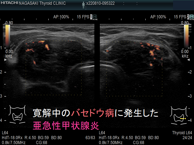寛解中のバセドウ病に発生した亜急性甲状腺炎 ドプラーモード 寛解中のバセドウ病に発生した亜急性甲状腺炎 ドプラーモード