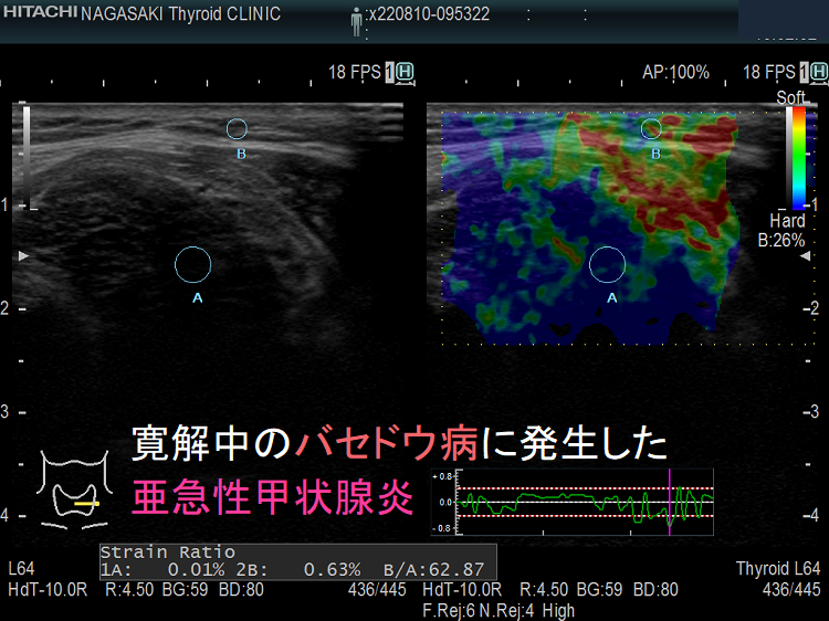 寛解中のバセドウ病に発生した亜急性甲状腺炎 エラストグラフィー 寛解中のバセドウ病に発生した亜急性甲状腺炎 エラストグラフィー