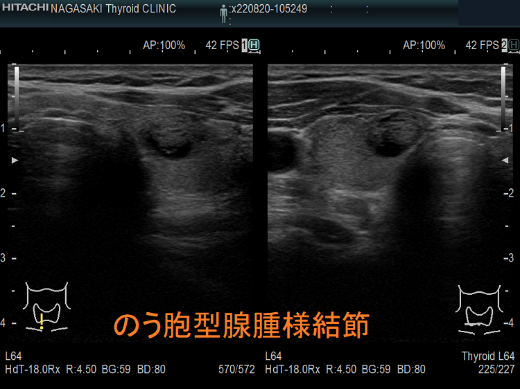 のう胞型腺腫様結節 超音波(エコー)画像 のう胞型腺腫様結節 超音波(エコー)画像