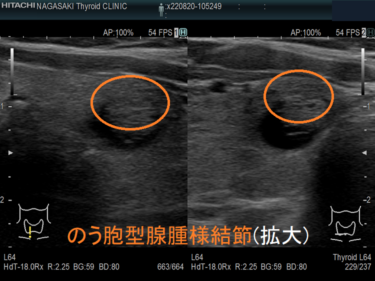 のう胞型腺腫様結節 超音波(エコー)画像 (拡大) のう胞型腺腫様結節 超音波(エコー)画像 (拡大)