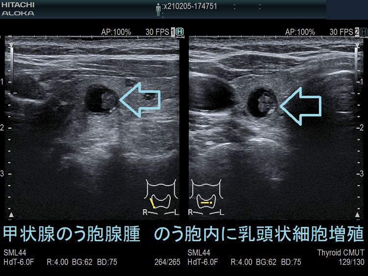 甲状腺のう胞腺腫 のう胞内に乳頭状の細胞増殖 甲状腺のう胞腺腫 のう胞内に乳頭状の細胞増殖