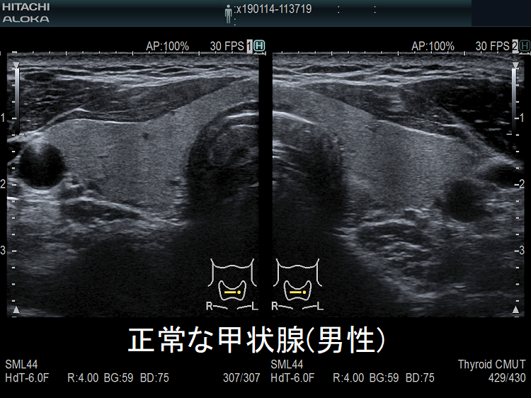 正常な甲状腺(男性) 正常な甲状腺(男性)
