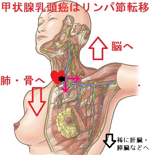 甲状腺乳頭癌 転移リンパ節の経路 甲状腺乳頭癌 転移リンパ節の経路