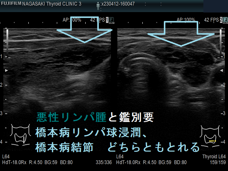 悪性リンパ腫と鑑別要 橋本病リンパ球浸潤、橋本病結節 どちらともとれる 悪性リンパ腫と鑑別要 橋本病リンパ球浸潤、橋本病結節 どちらともとれる