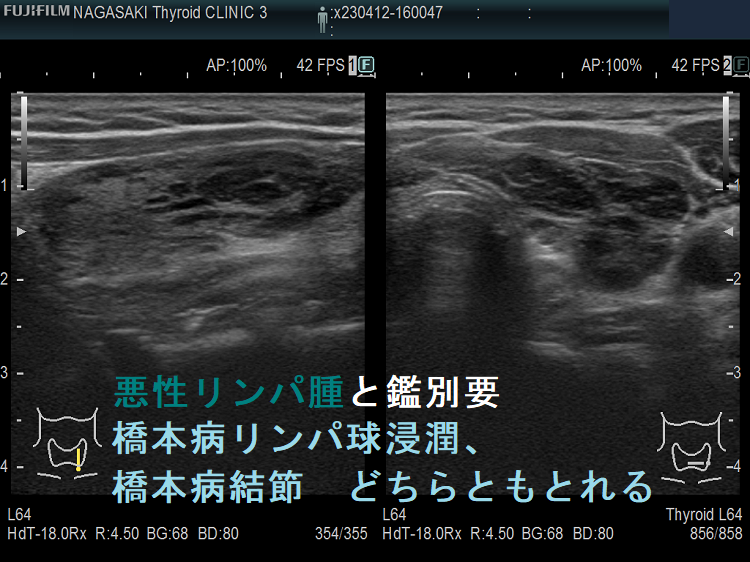悪性リンパ腫と鑑別要 橋本病リンパ球浸潤、橋本病結節 どちらともとれる ゲイン補正後 悪性リンパ腫と鑑別要 橋本病リンパ球浸潤、橋本病結節 どちらともとれる ゲイン補正後