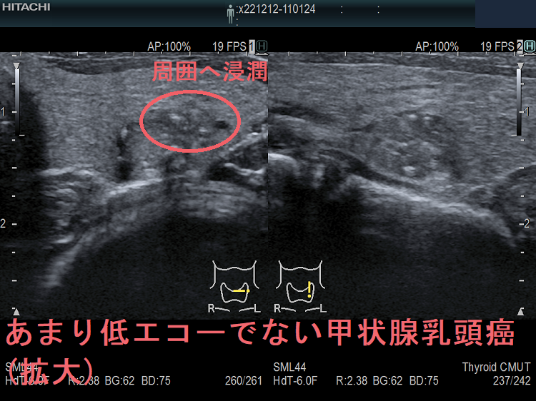 あまり低エコーでない甲状腺乳頭癌(拡大) あまり低エコーでない甲状腺乳頭癌(拡大)