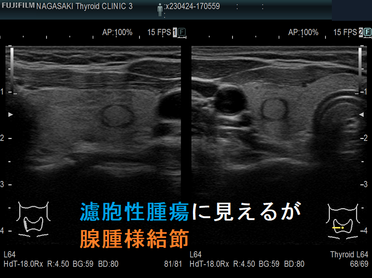 濾胞性腫瘍でなく腺腫様結節 超音波(エコー)画像 濾胞性腫瘍でなく腺腫様結節 超音波(エコー)画像
