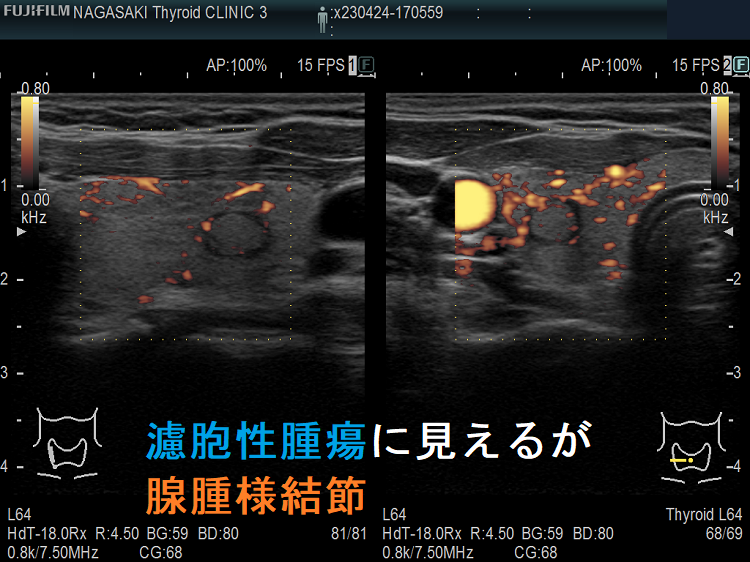 濾胞性腫瘍でなく腺腫様結節 超音波(エコー)画像 ドプラーモード 濾胞性腫瘍でなく腺腫様結節 超音波(エコー)画像 ドプラーモード