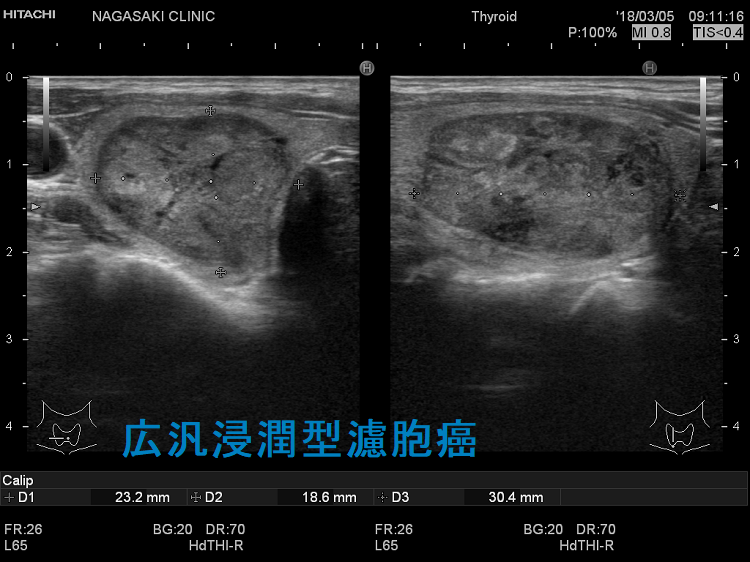 広汎浸潤型甲状腺濾胞癌 超音波(エコー)画像 広汎浸潤型甲状腺濾胞癌 超音波(エコー)画像