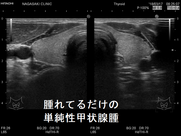 腫れてるだけの単純性甲状腺腫 腫れてるだけの単純性甲状腺腫