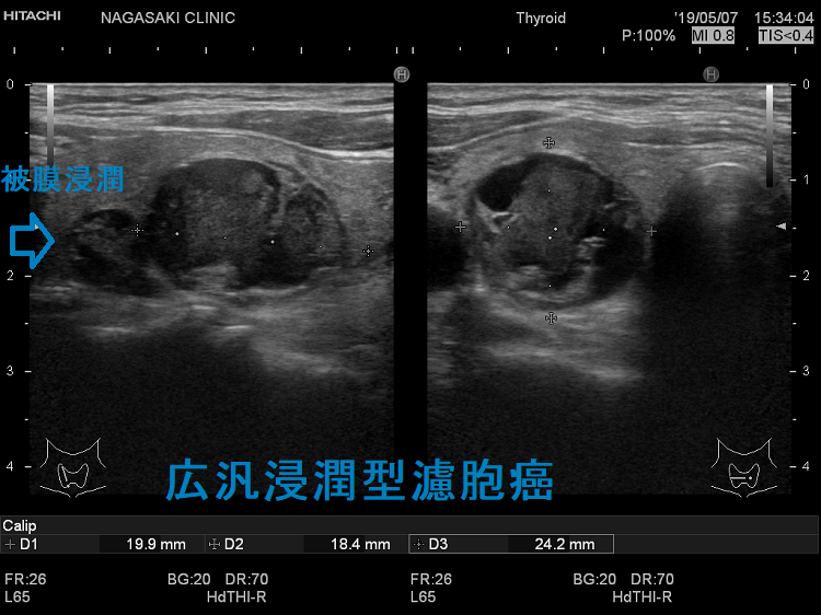 甲状腺濾胞癌[橋本病 バセドウ病 超音波検査エコー 甲状腺 専門医 長崎