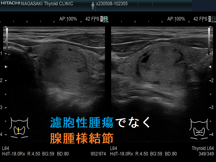 濾胞性腫瘍に見えるが腺腫様結節 超音波(エコー)画像 濾胞性腫瘍に見えるが腺腫様結節 超音波(エコー)画像
