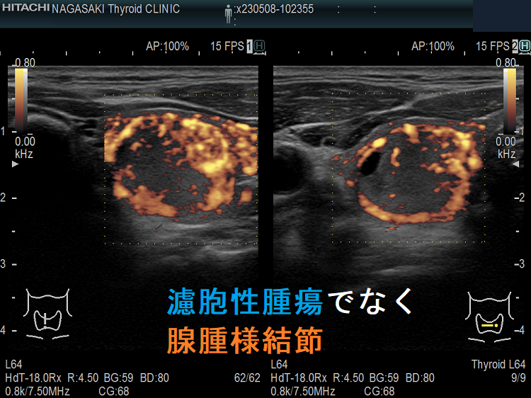 濾胞性腫瘍に見えるが腺腫様結節 超音波(エコー)画像 ドプラーモード 濾胞性腫瘍に見えるが腺腫様結節 超音波(エコー)画像 ドプラーモード