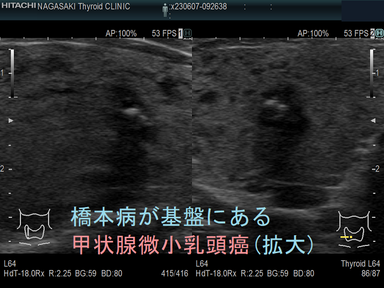 橋本病が基盤にある甲状腺微小乳頭癌 (拡大) 橋本病が基盤にある甲状腺微小乳頭癌(拡大)